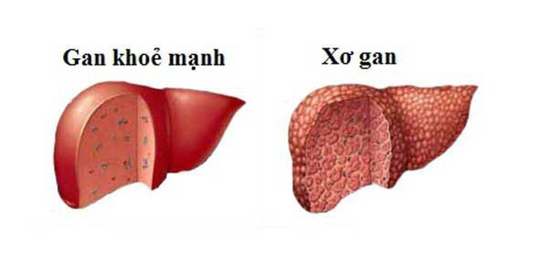 80% các trường hợp bệnh nhân bị xơ gan tiến triển thành ung thư gan